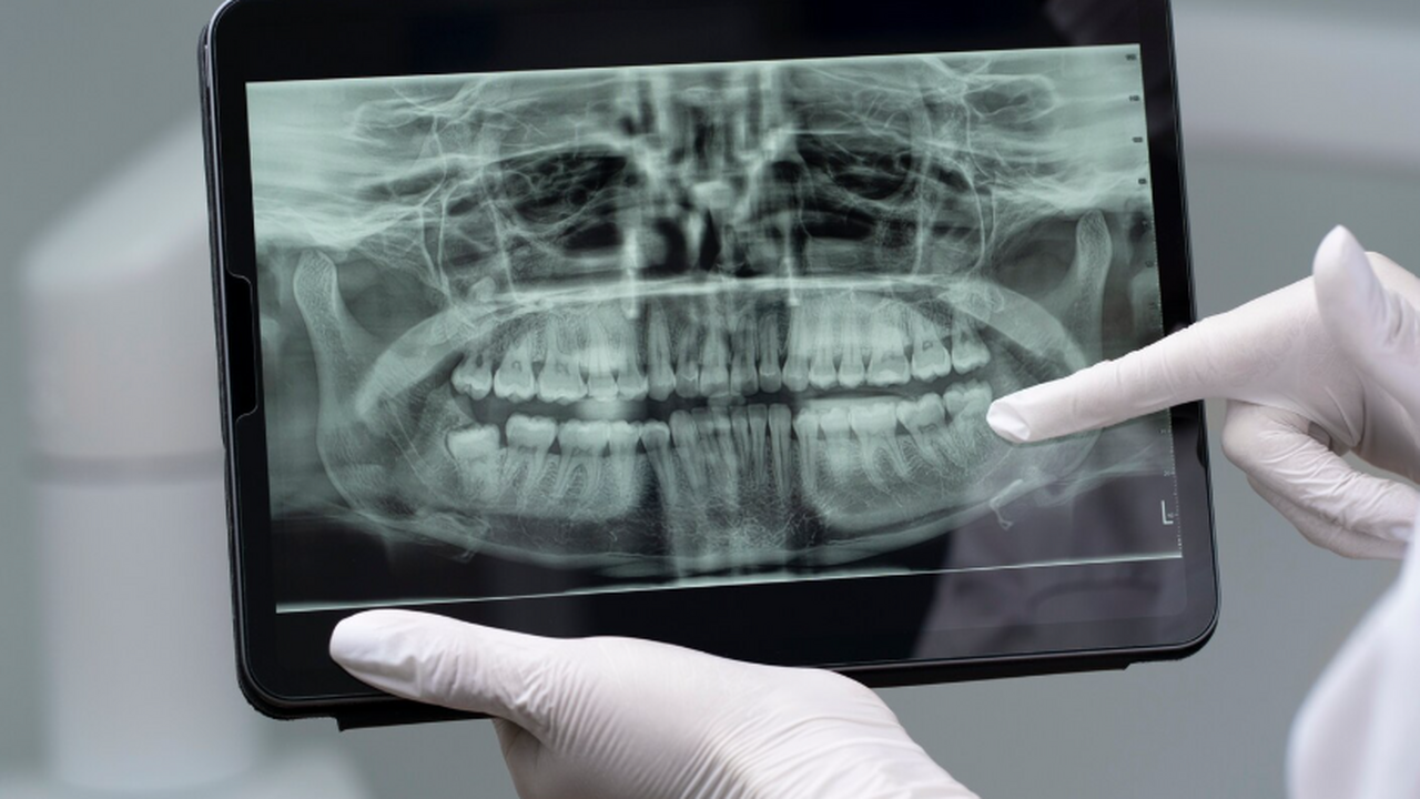 JAMA: из-за припухлости нижней челюсти китайцу диагностировали синдром SAPHO В журнале JAMA Otolaryngology—Head & Neck Surge...