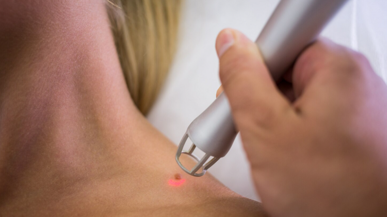 Редкие генетические мутации ведут к появлению неизлечимых плоских папиллом Учёные обнаружили редкие генетические мутации у...