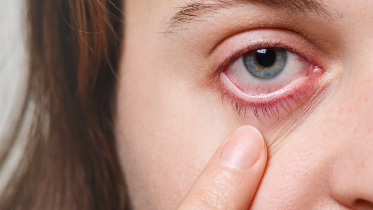 EID: паразит Philophthalmus от галапагосских львов попал в глаз женщины Учёные из различных стран описали уникальный сл...