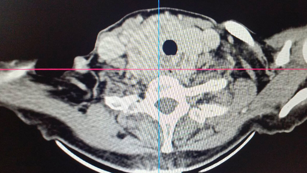 В Клиниках СамГМУ успешно прооперировали пациентку с гигантским застарелым зобом Осложнения могли привести к проблемам сердечно-...
